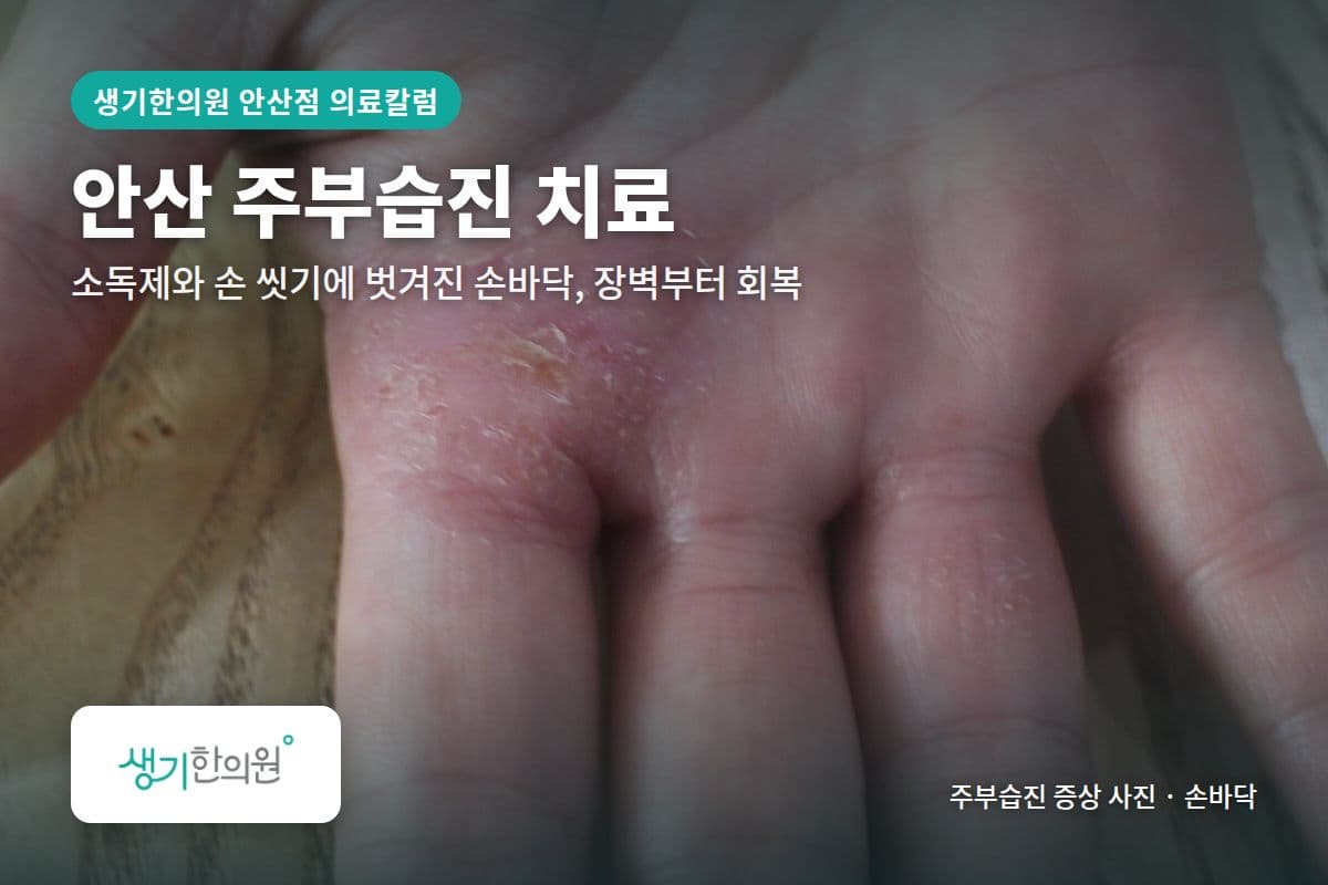 손바닥 주부습진 증상 사진과 문구 「안산 주부습진 치료, 소독제와 손 씻기에 벗겨진 손바닥, 장벽부터 회복 · 생기한의원 안산점」