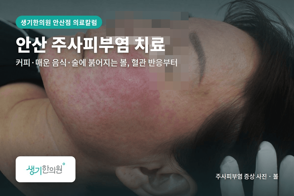 볼 주사피부염 증상 사진과 문구 「안산 주사피부염 치료, 커피·매운 음식·술에 붉어지는 볼, 혈관 반응부터 · 생기한의원 안산점」
