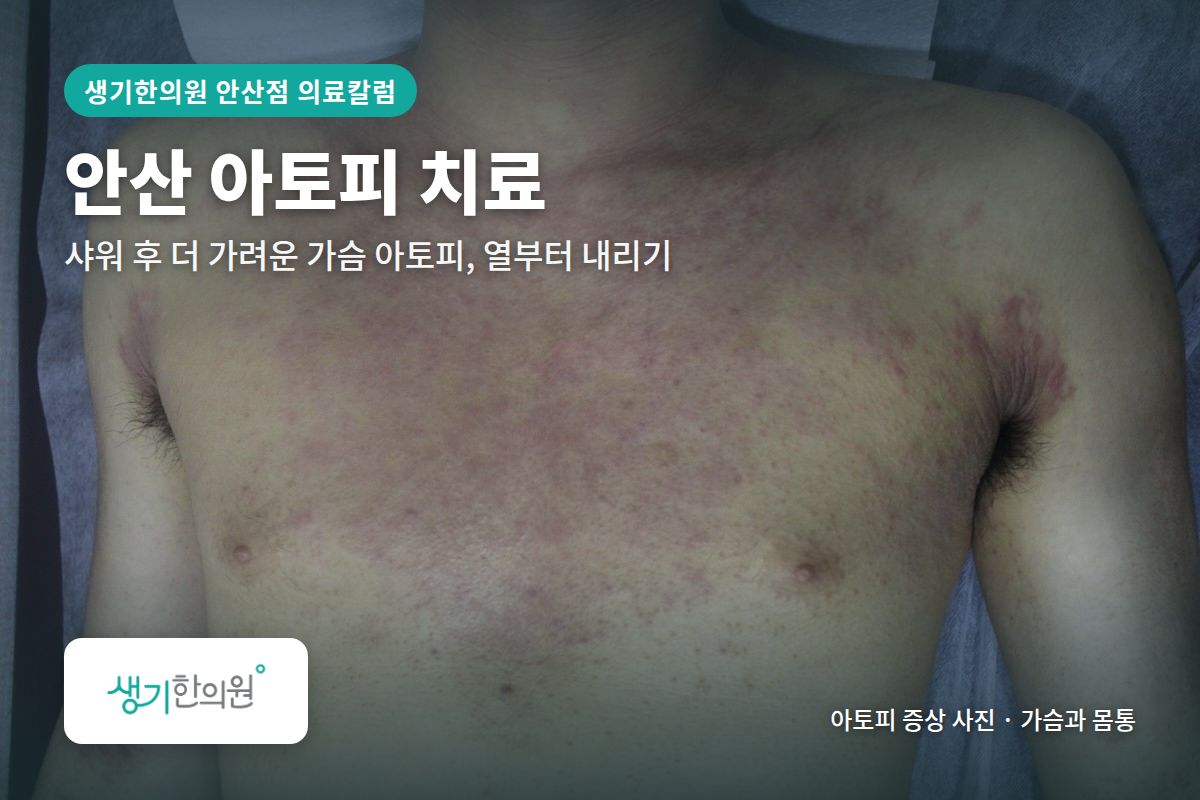 가슴과 몸통 아토피 증상 사진과 문구 「안산 아토피 치료, 샤워 후 더 가려운 가슴 아토피, 열부터 내리기 · 생기한의원 안산점」