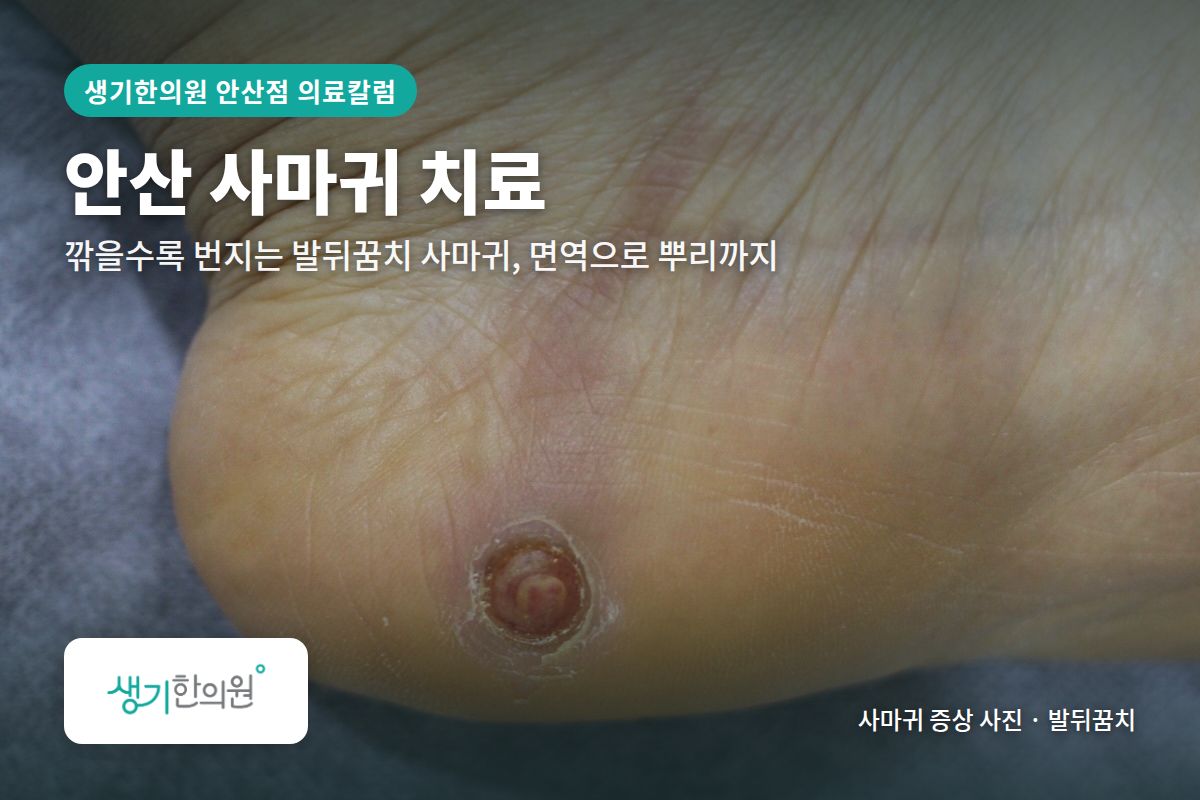 발뒤꿈치 사마귀 증상 사진과 문구 「안산 사마귀 치료, 깎을수록 번지는 발뒤꿈치 사마귀, 면역으로 뿌리까지 · 생기한의원 안산점」